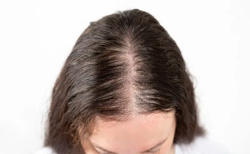 Does Ozempic Cause Hair Loss
