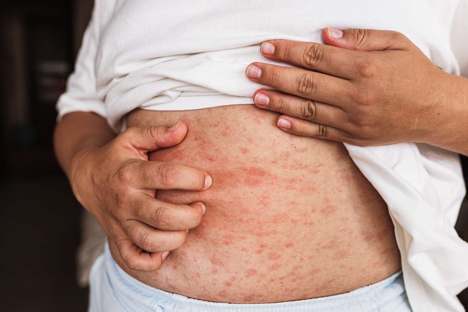 Tirzepatide & Zepbound Rash and Injection-Site Reactions: Causes,  Treatment, and Prevention