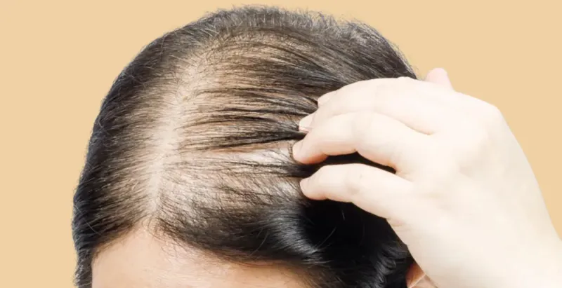Can You Lower Your Risk of Hair Loss While Taking Ozempic
