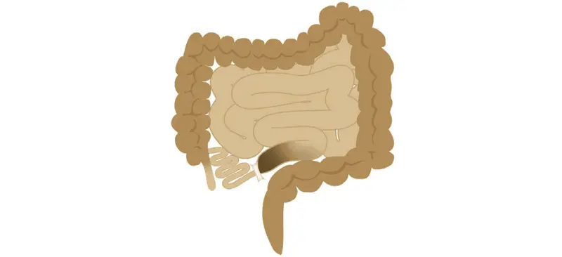 Can Ozempic or Wegovy Cause a Bowel Blockage?
