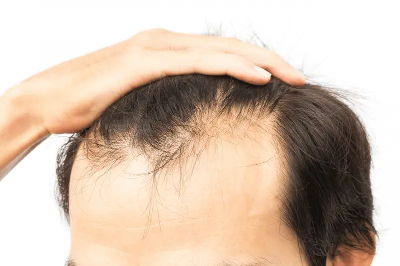 Why Does Ozempic Cause Hair Loss
