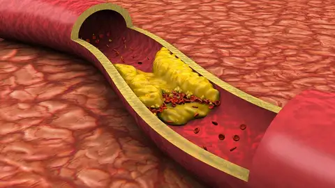 Does Mounjaro Lower Cholesterol?