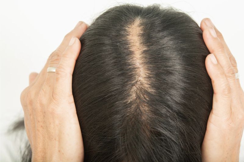 Does Semaglutide Cause Hair Loss and How Can You Reduce It?