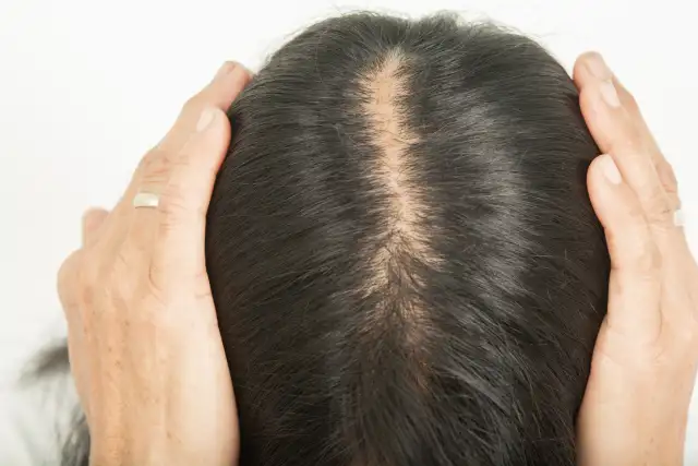 Does Semaglutide Cause Hair Loss and How Can You Reduce It?