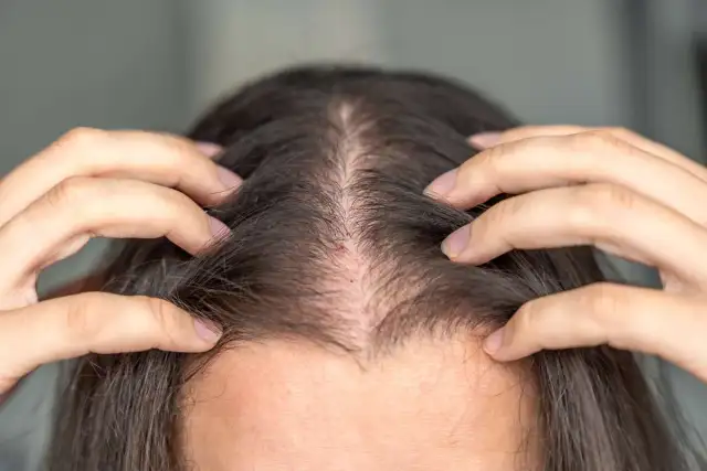 Does Tirzepatide Cause Hair Loss & What You Can Do about It?