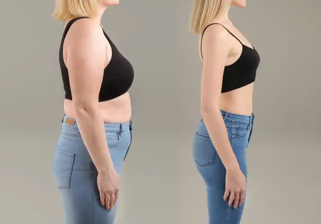 What Do Semaglutide Before and After Results Actually Look Like?