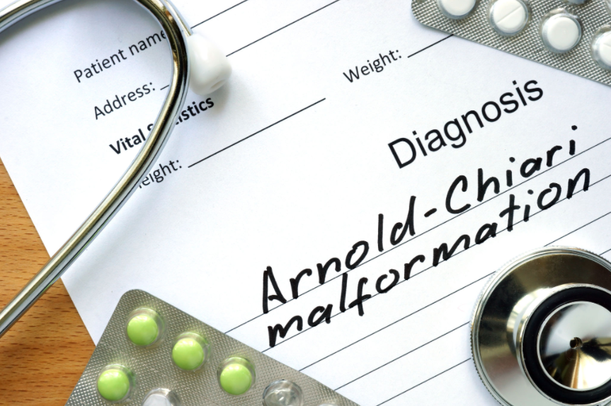 Arnold-Chiari malformasyonu, beyinciğin alt kısımlarının omurilik kanalına doğru yer değiştirmesiyle karakterize doğumsal bir nörolojik bozukluktur. Genellikle baş ağrısı, denge sorunları, yutma güçlüğü ve kol-bacaklarda güç kaybı gibi belirtilerle kendini gösterir. Chiari malformasyonu; Tip 1’den Tip 4’e kadar dört ana sınıfta incelenir ve bu tipler, sarkmanın şiddeti ve eşlik eden diğer anormalliklere göre ayrılır. Tanıda en önemli araç beyin ve omurilik MR görüntülemeleridir. Tedavi, bulguların şiddetine göre takipten cerrahi müdahaleye kadar değişebilir.