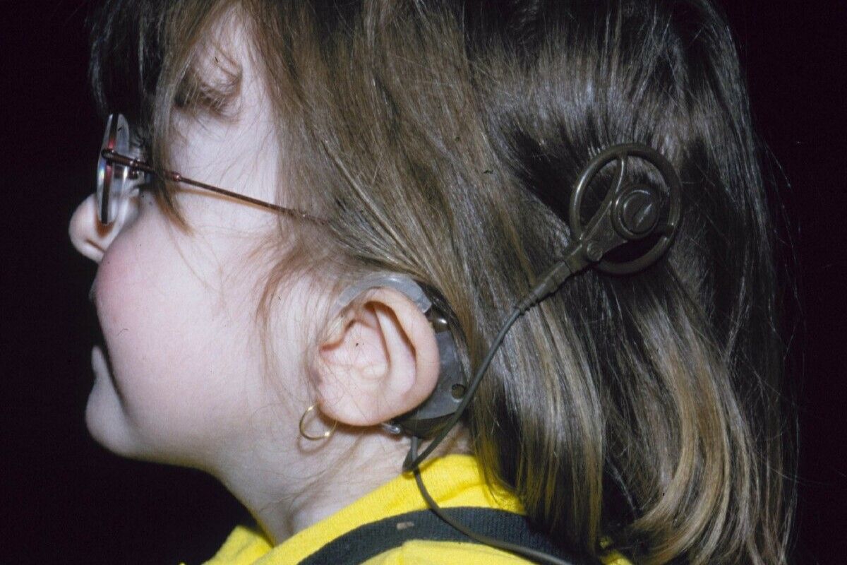 CHARGE sendromlu çocukta kemik iletimli işitme cihazı kullanımı ve kulak anomalileri