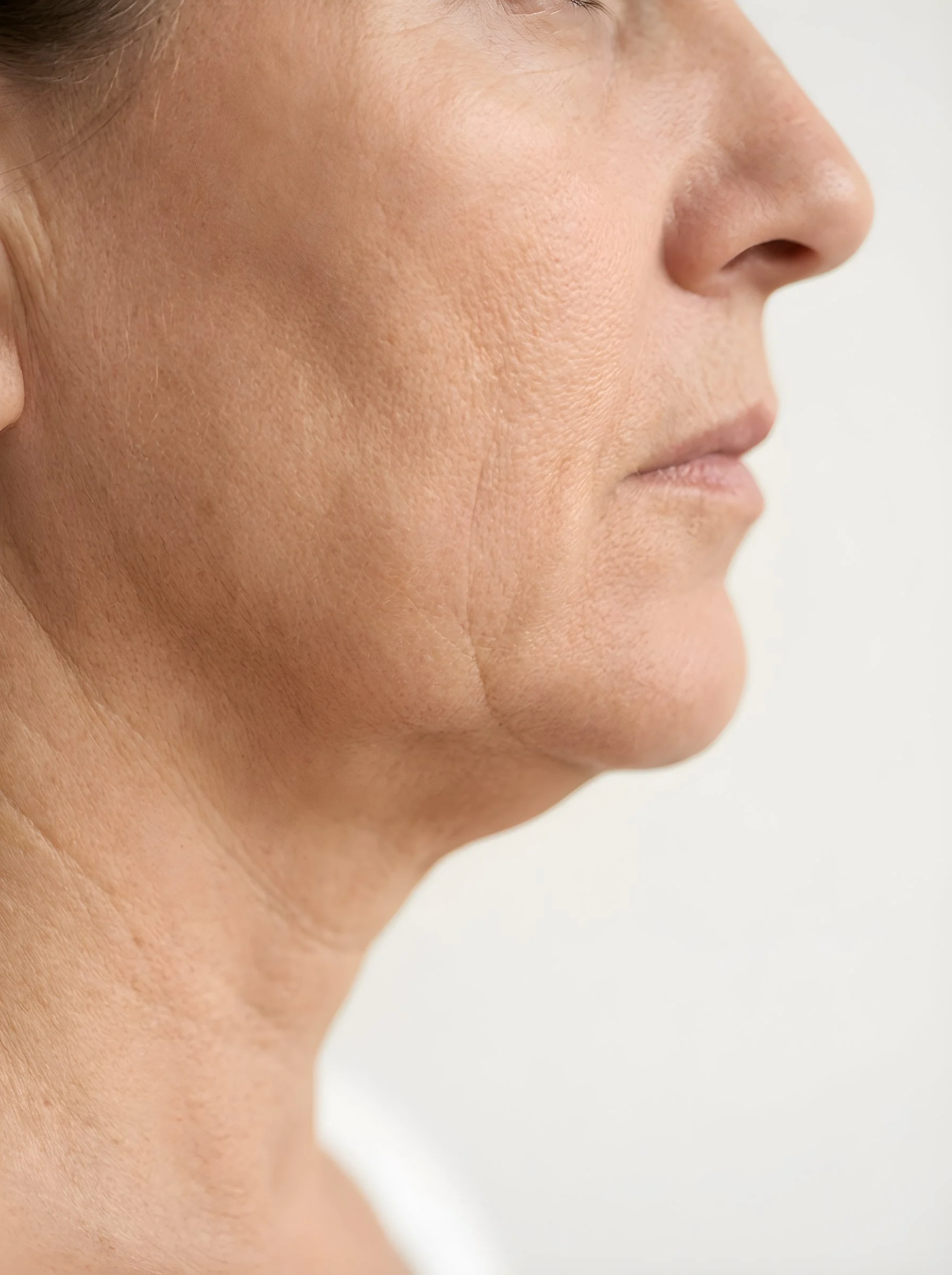 Close-up profile showing skin laxity and sagging along the jaw