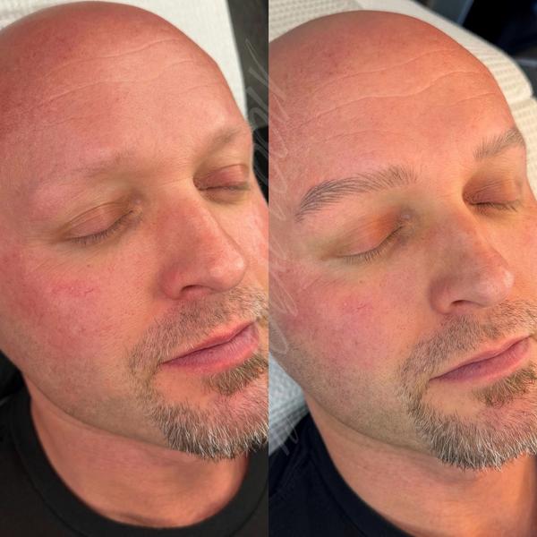 Healed Nano Brow Alopecia Brow Restoration 