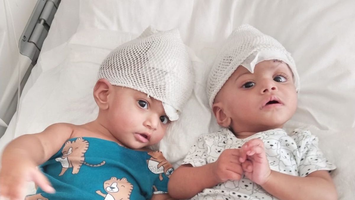 The twins after surgery