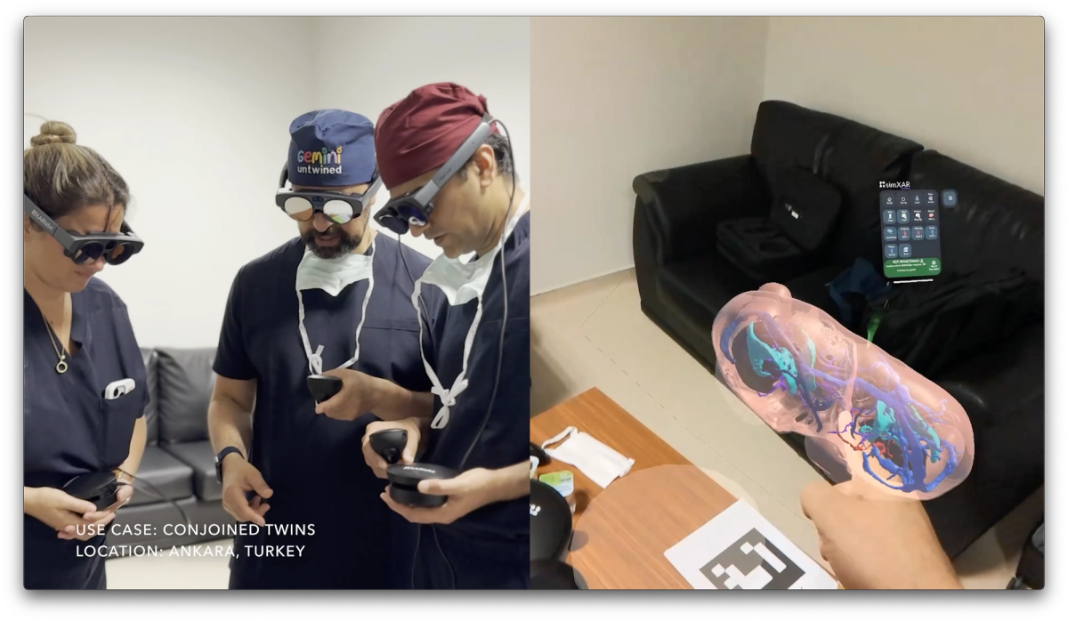 Visualisation of conjoined twins with surgeons