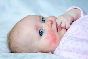 Baby mit geröteten Hautstellen im Gesicht.