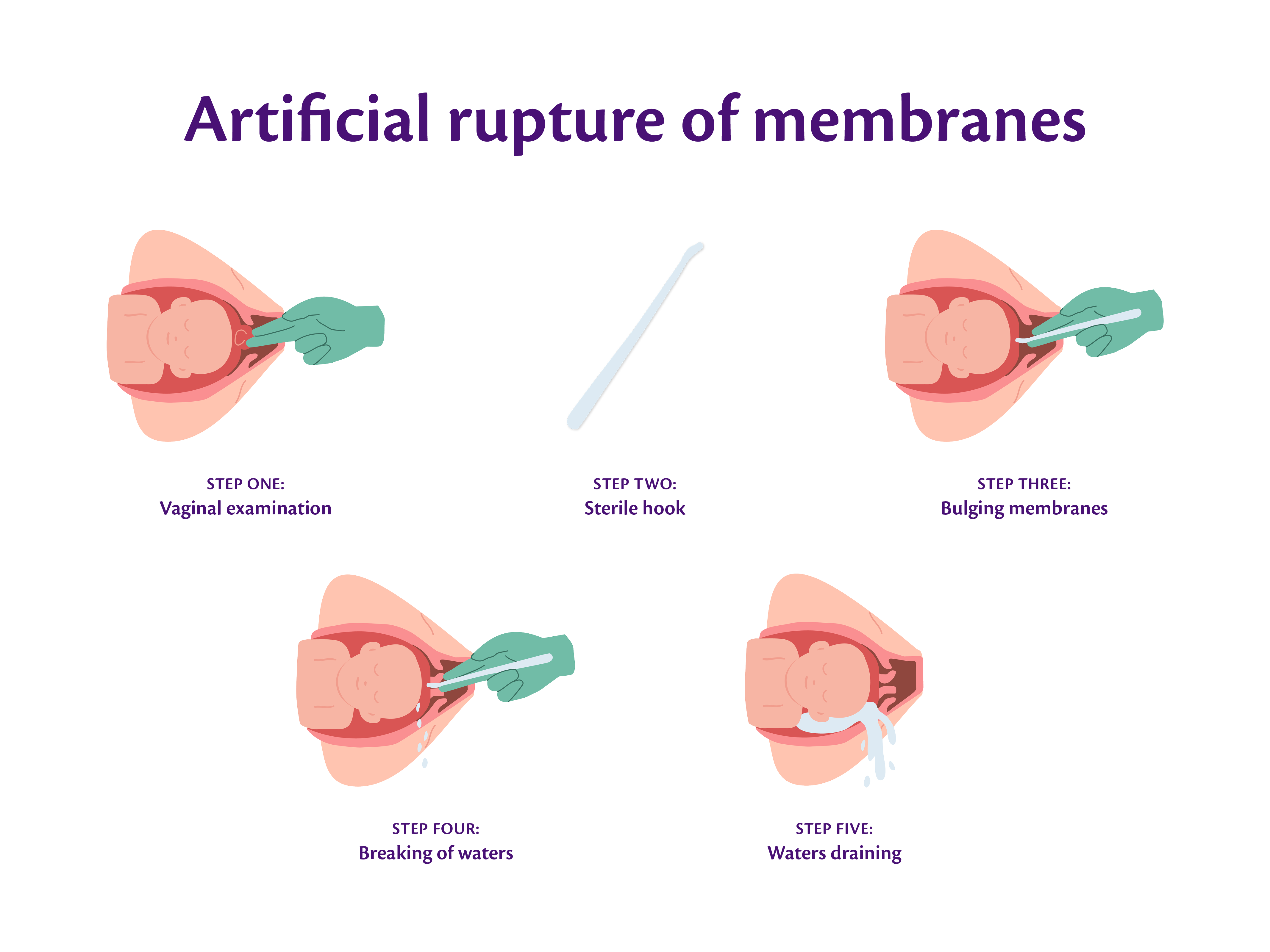 Graphic showcasing the process of artificially rupturing membranes during labour & birth