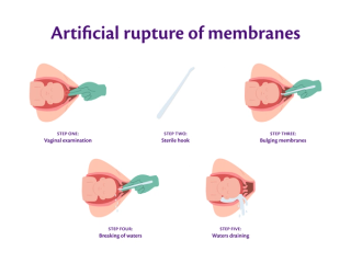 Graphic showcasing the process of artificially rupturing membranes during labour & birth