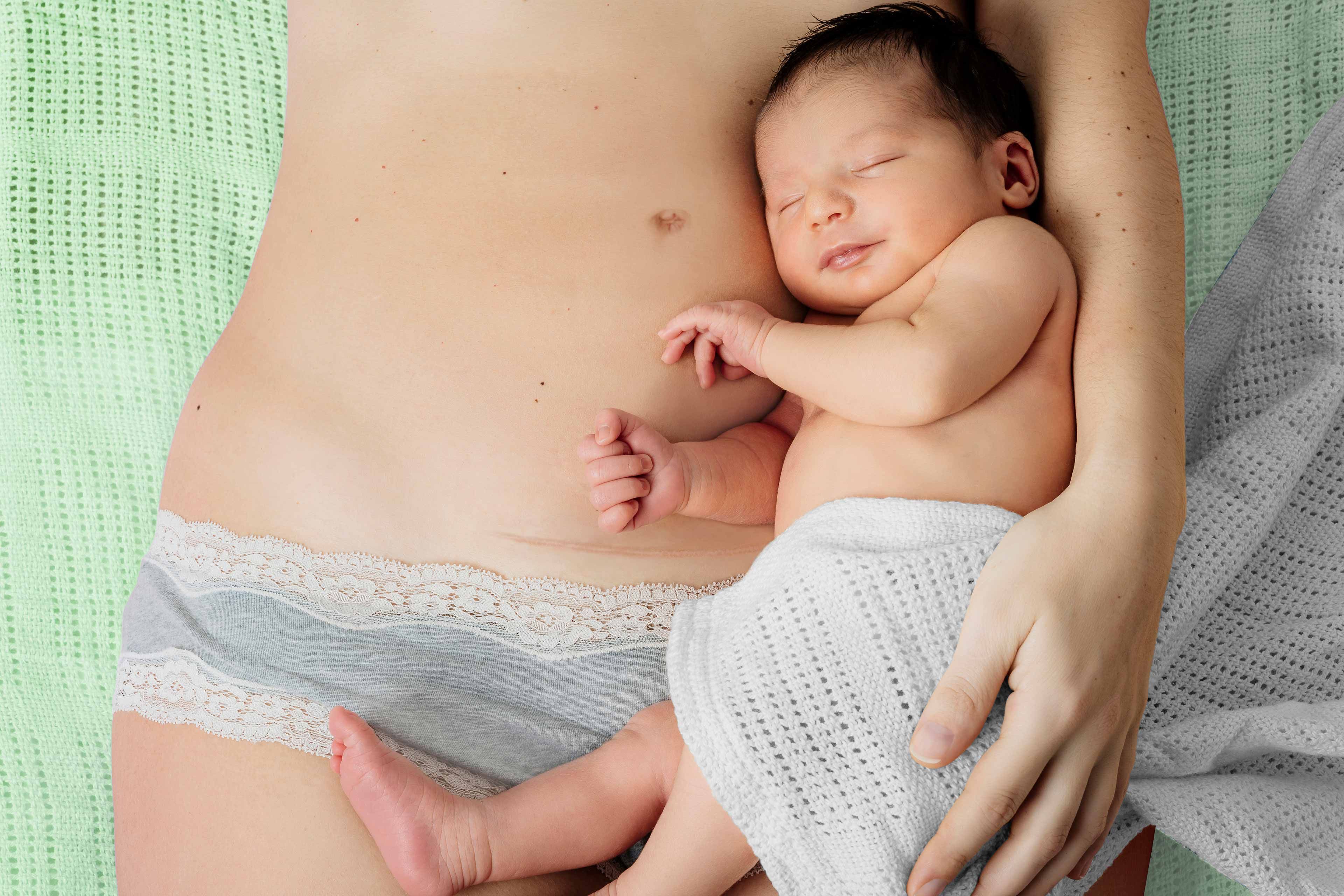 Frau liegt auf dem Rücken mit sichtbarer Kaiserschnittnarbe am Unterbauch und hält ein nacktes Baby mit weißer Decke im Arm