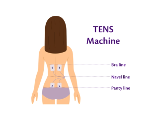 Infographic showing where to place TENS machine pads for pain relief during labor and birth