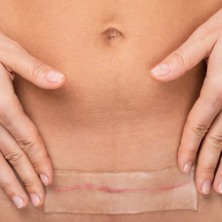 Woman's torso applying silcone patch to c-section scar