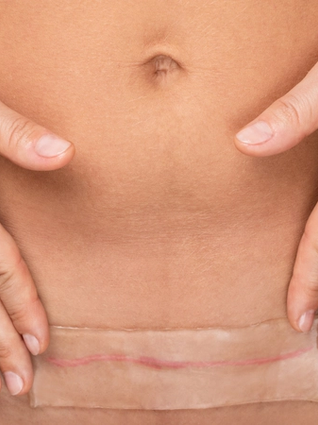 Woman's torso applying silcone patch to c-section scar