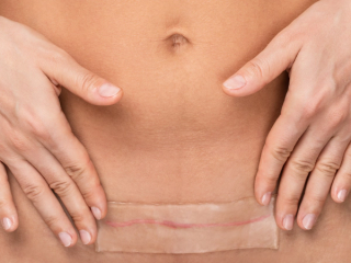 Woman's torso applying silcone patch to c-section scar