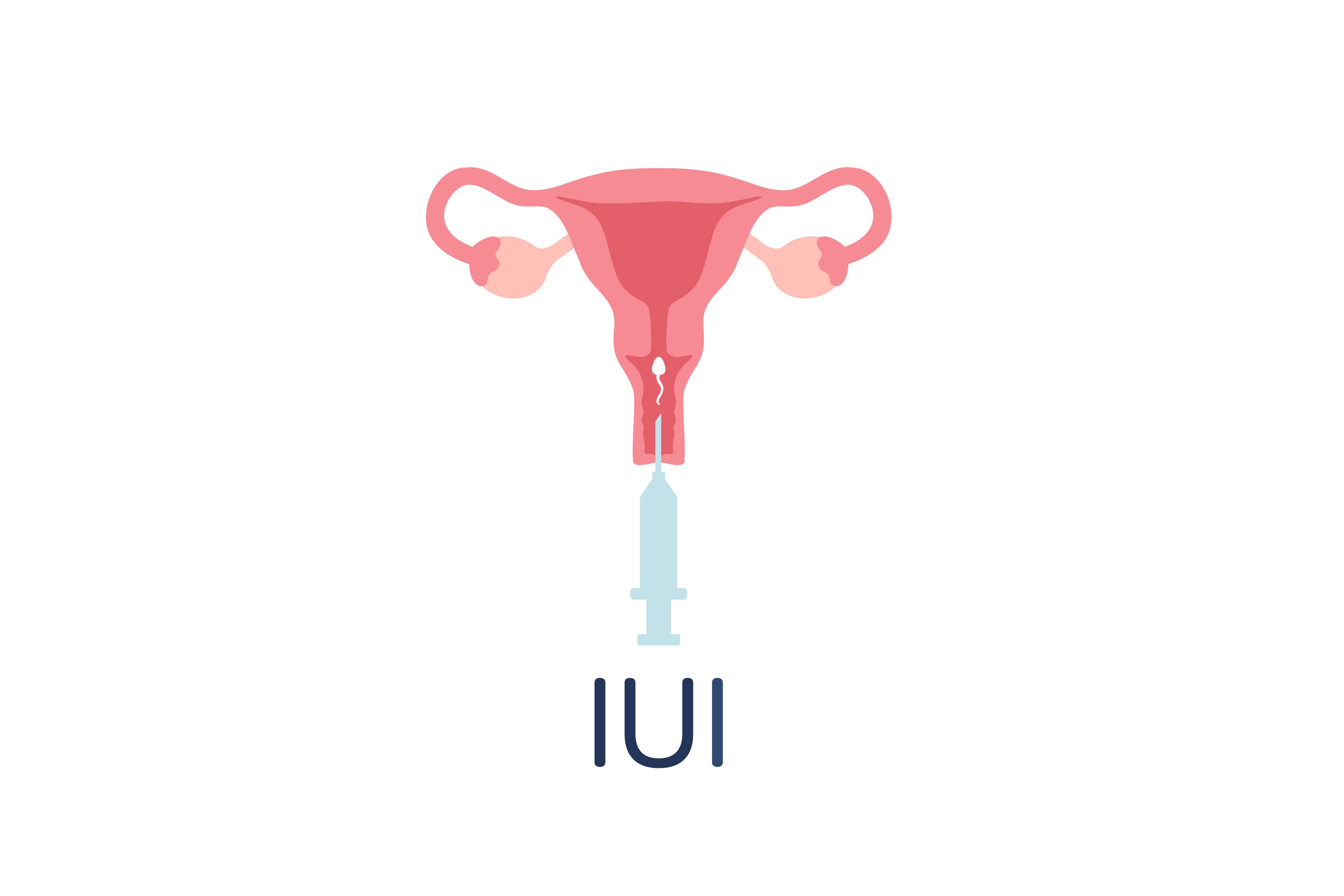Ein weibliches Fortpflanzungssystem, in das eine Spritze mit der Aufschrift "IUI" eingeführt wurde.