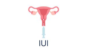 Ein weibliches Fortpflanzungssystem, in das eine Spritze mit der Aufschrift "IUI" eingeführt wurde.