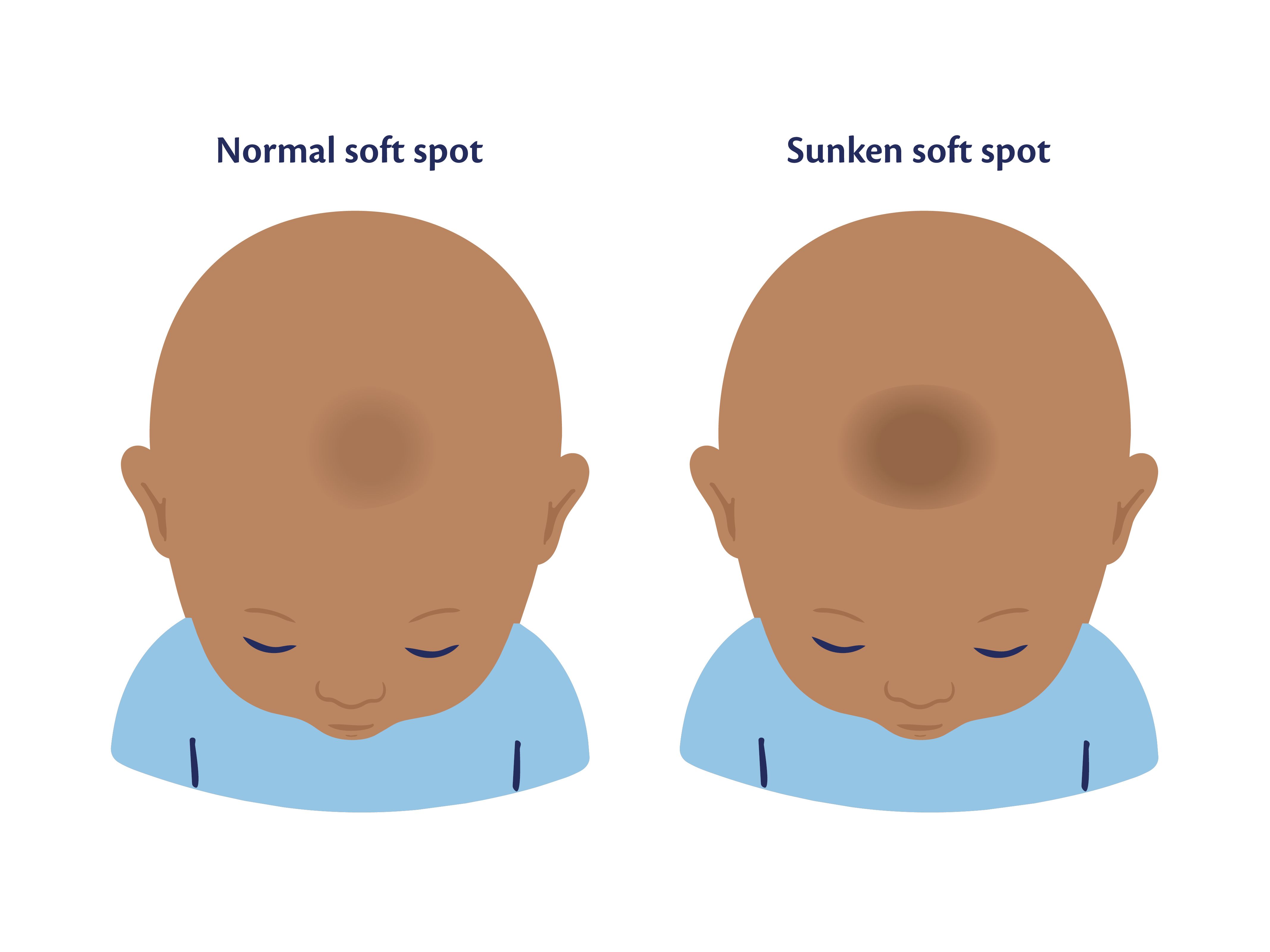A side-by-side comparison diagram of a baby's head from a top-down view. On the left, the baby's head has a slightly shaded area labeled 'Normal soft spot'. On the right, the baby's head has a noticeably deeper, darker shaded indentation labeled 'Sunken soft spot'.