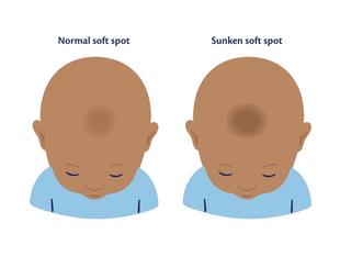 A side-by-side comparison diagram of a baby's head from a top-down view. On the left, the baby's head has a slightly shaded area labeled 'Normal soft spot'. On the right, the baby's head has a noticeably deeper, darker shaded indentation labeled 'Sunken soft spot'.