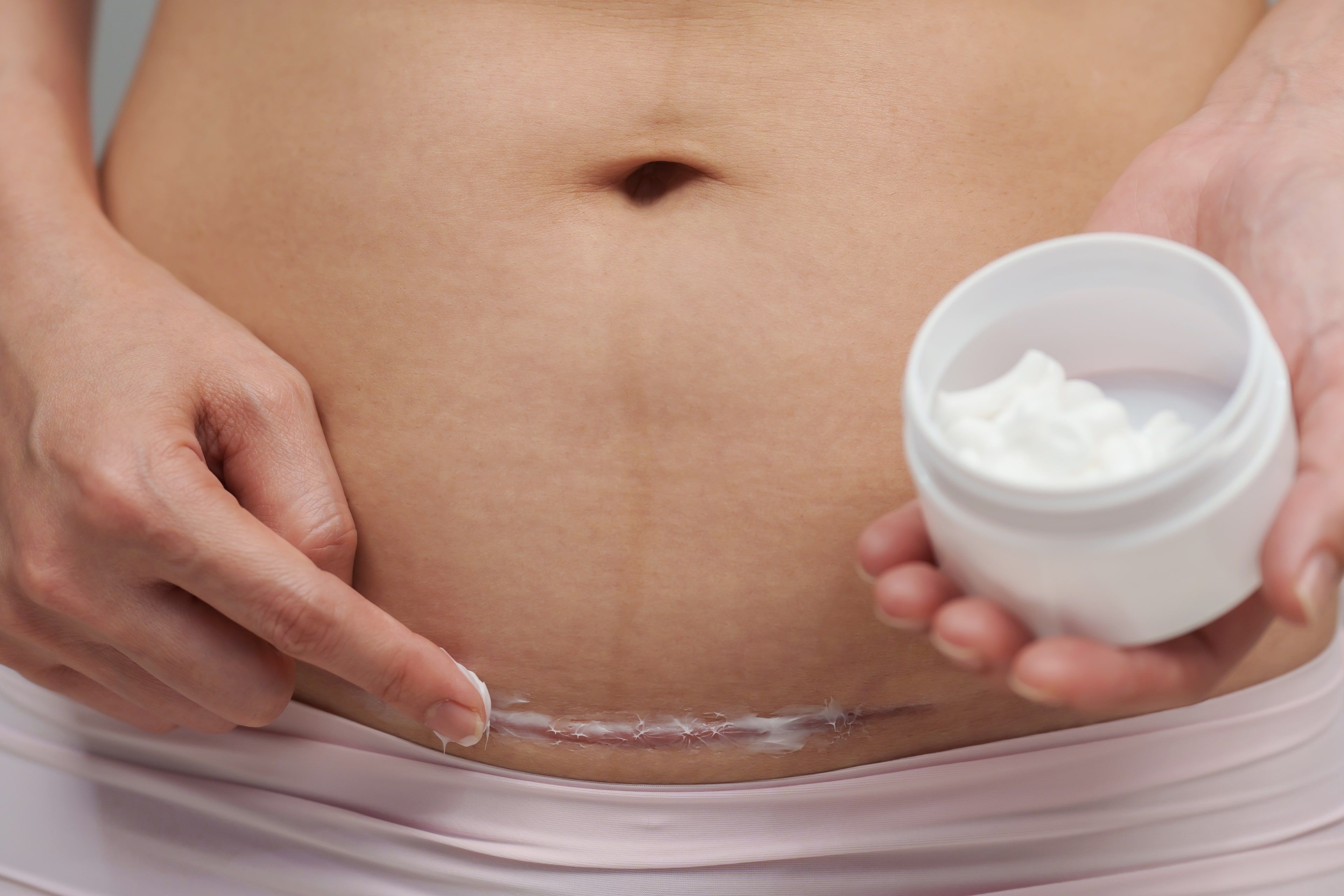 Eine Person trägt eine Creme auf eine Narbe auf ihrem Bauch auf.