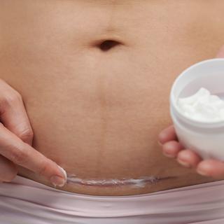 Eine Person trägt eine Creme auf eine Narbe auf ihrem Bauch auf.