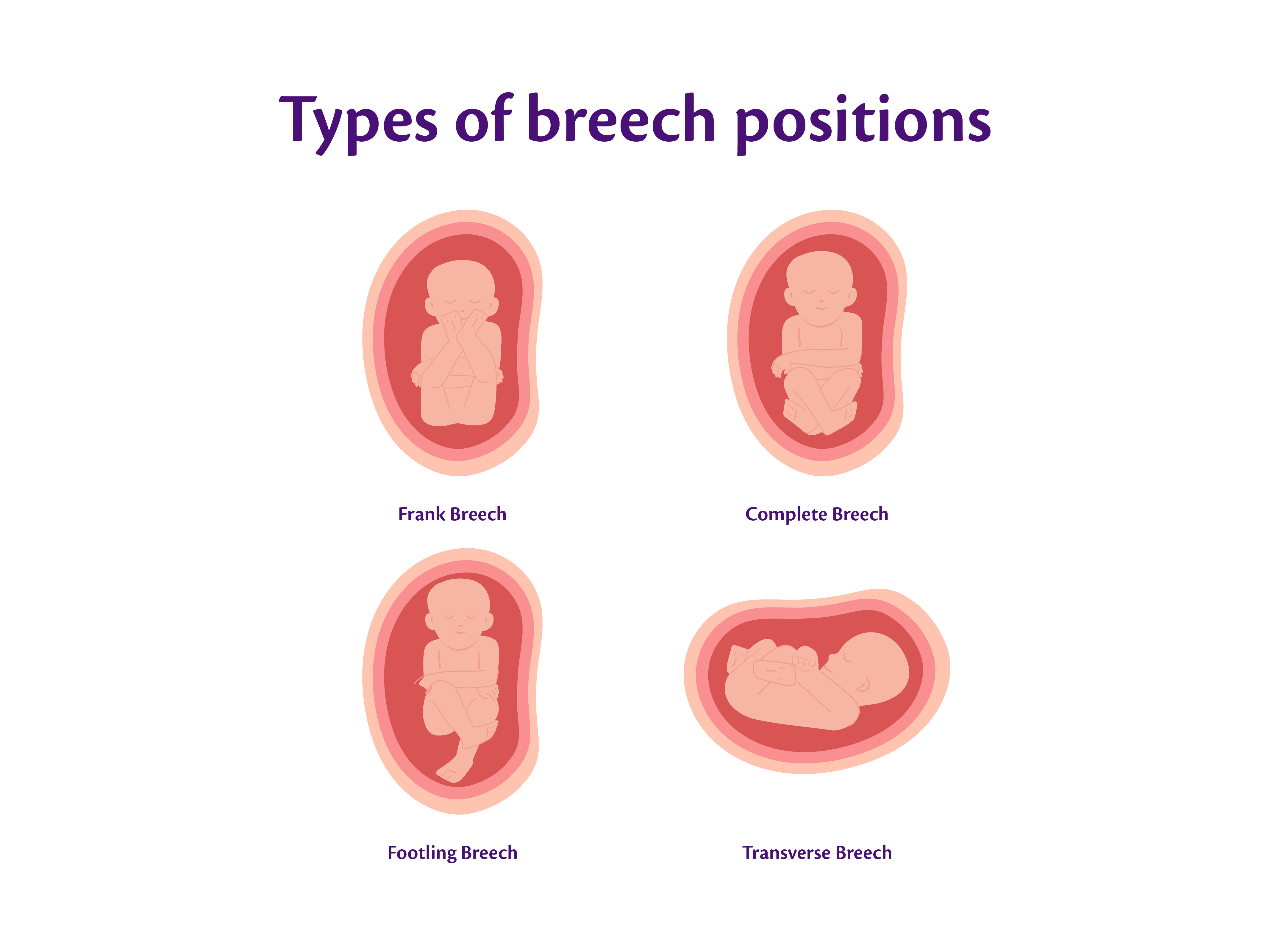Infographic visually representing the different types of breech positions
