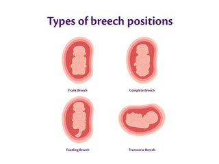 Infographic visually representing the different types of breech positions