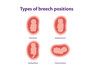 Infographic visually representing the different types of breech positions
