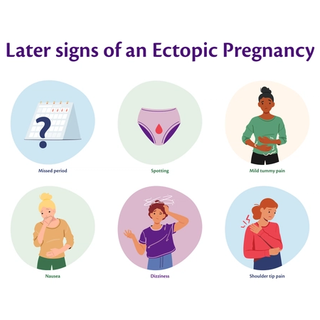 Graphic visually demonstrating the later signs of an ectopic pregnancy