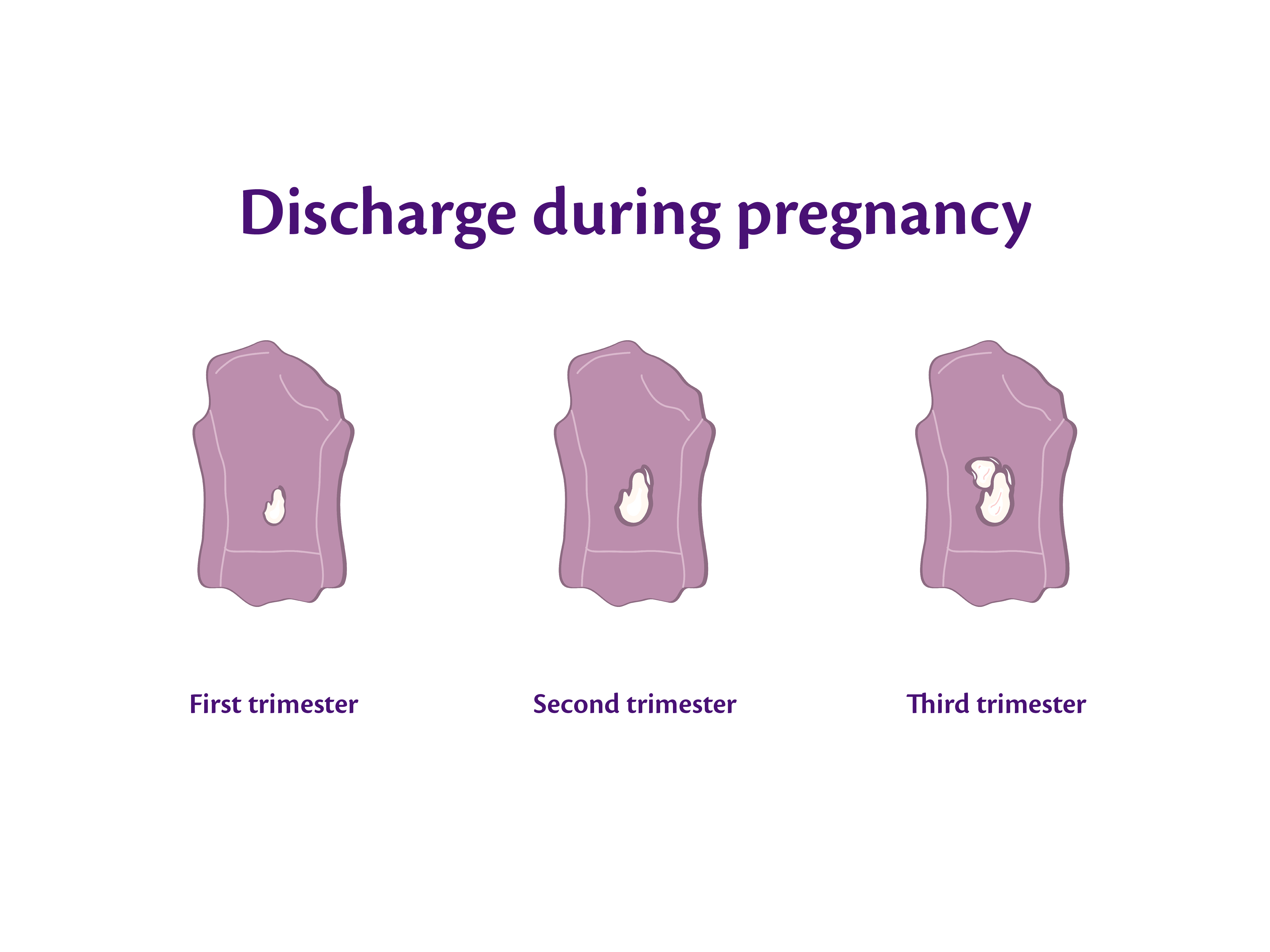 Diagram showing panty liners labelled first, second and third trimester, with increasing amounts of white vaginal discharge.