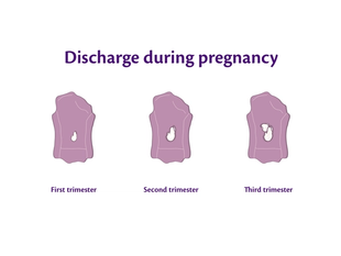 Diagram showing panty liners labelled first, second and third trimester, with increasing amounts of white vaginal discharge.