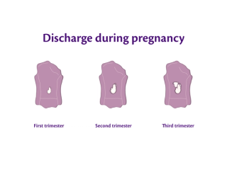 Diagram showing panty liners labelled first, second and third trimester, with increasing amounts of white vaginal discharge.