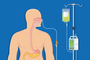 Grafische Darstellung eines Menschen mit einer Nasensonde, die durch die Nase bis in den Magen führt, verbunden mit einem Infusionsbeutel und einem Messgerät an einem Infusionsständer