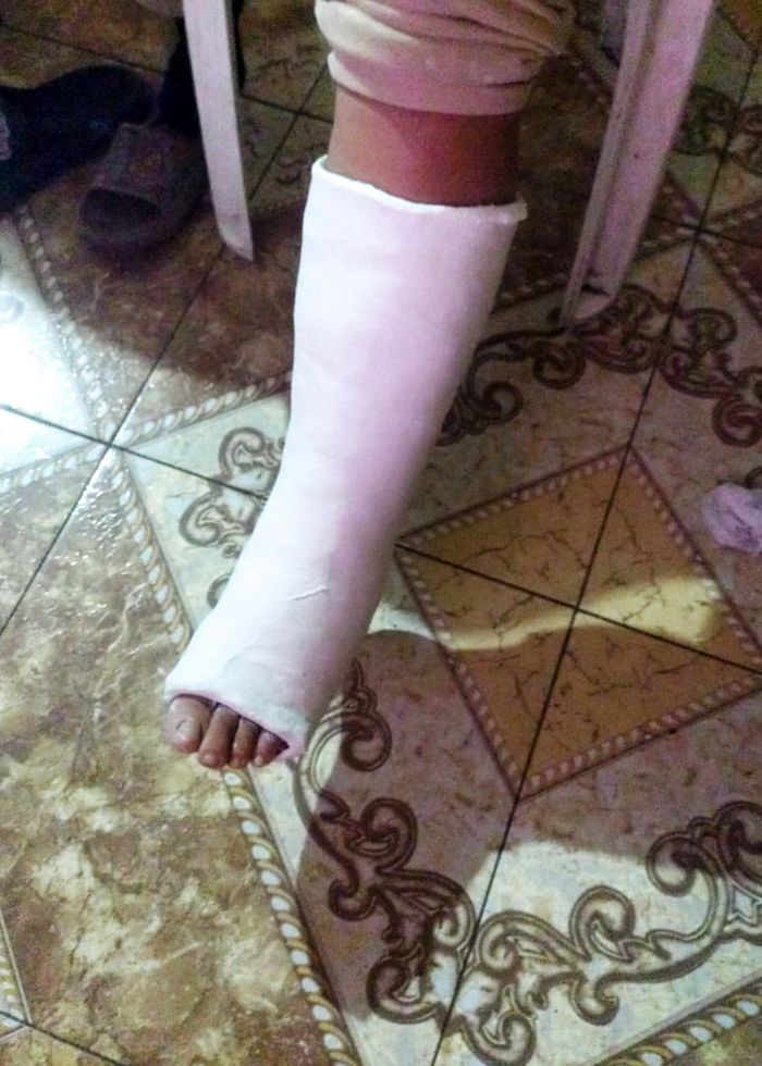 La pierna enyesada de Jenny tras el accidente