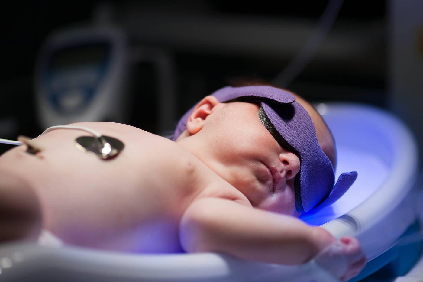 Newborn being treated for jaundice
