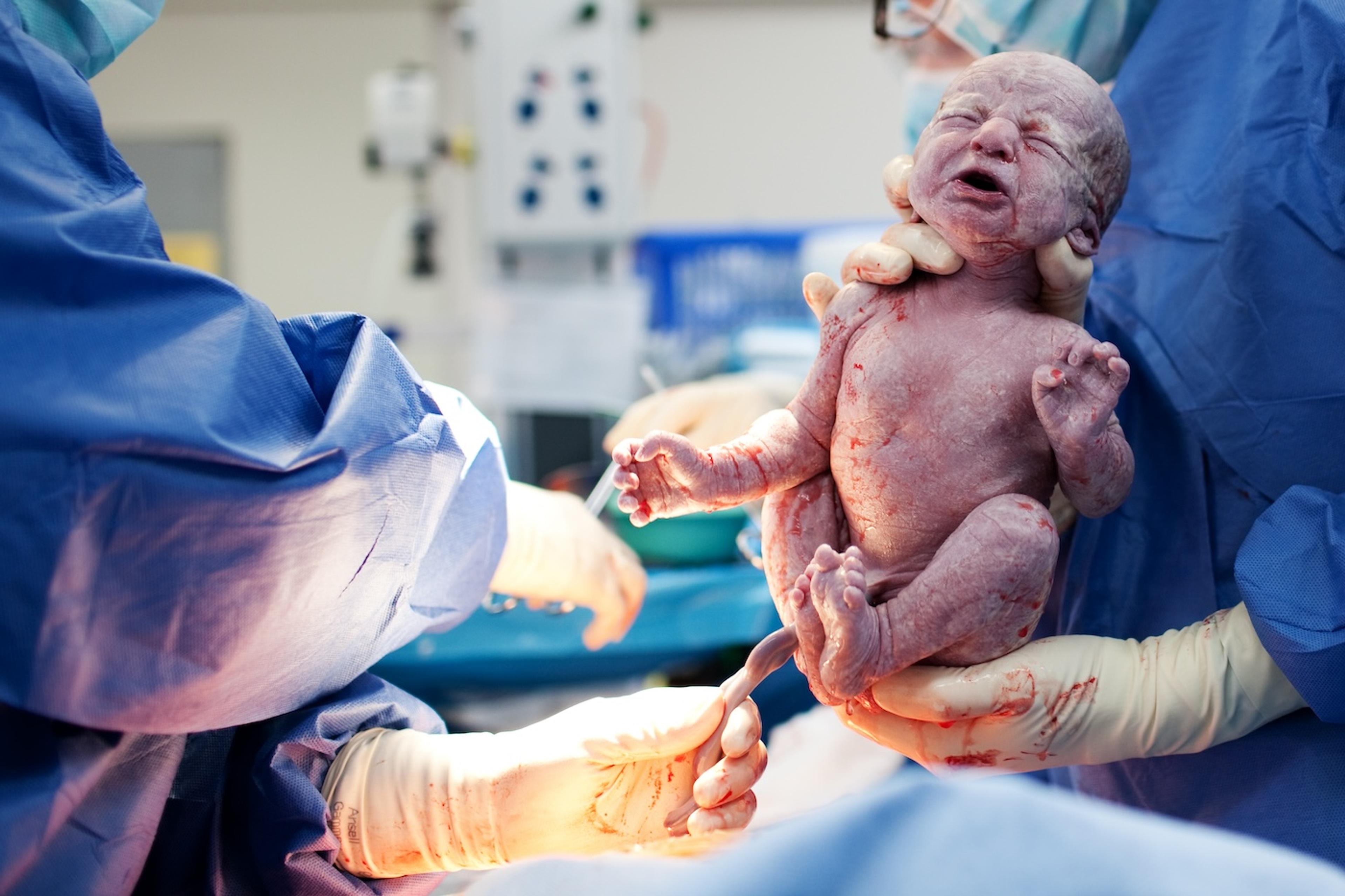 A baby is delivered via c-section