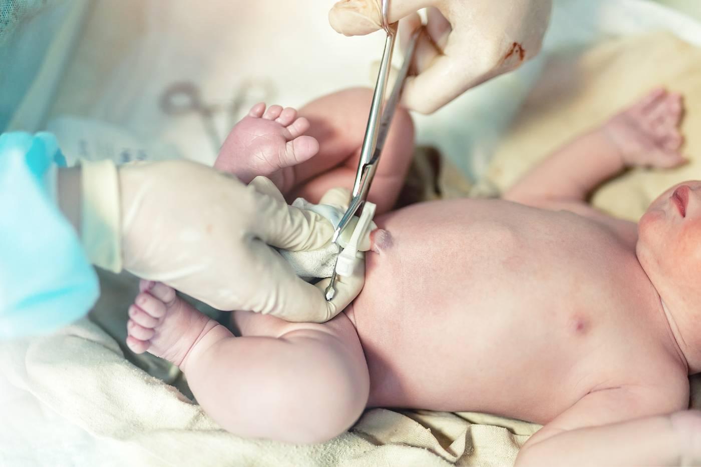 An infant has their umbilical cord cut and clamped after delivery
