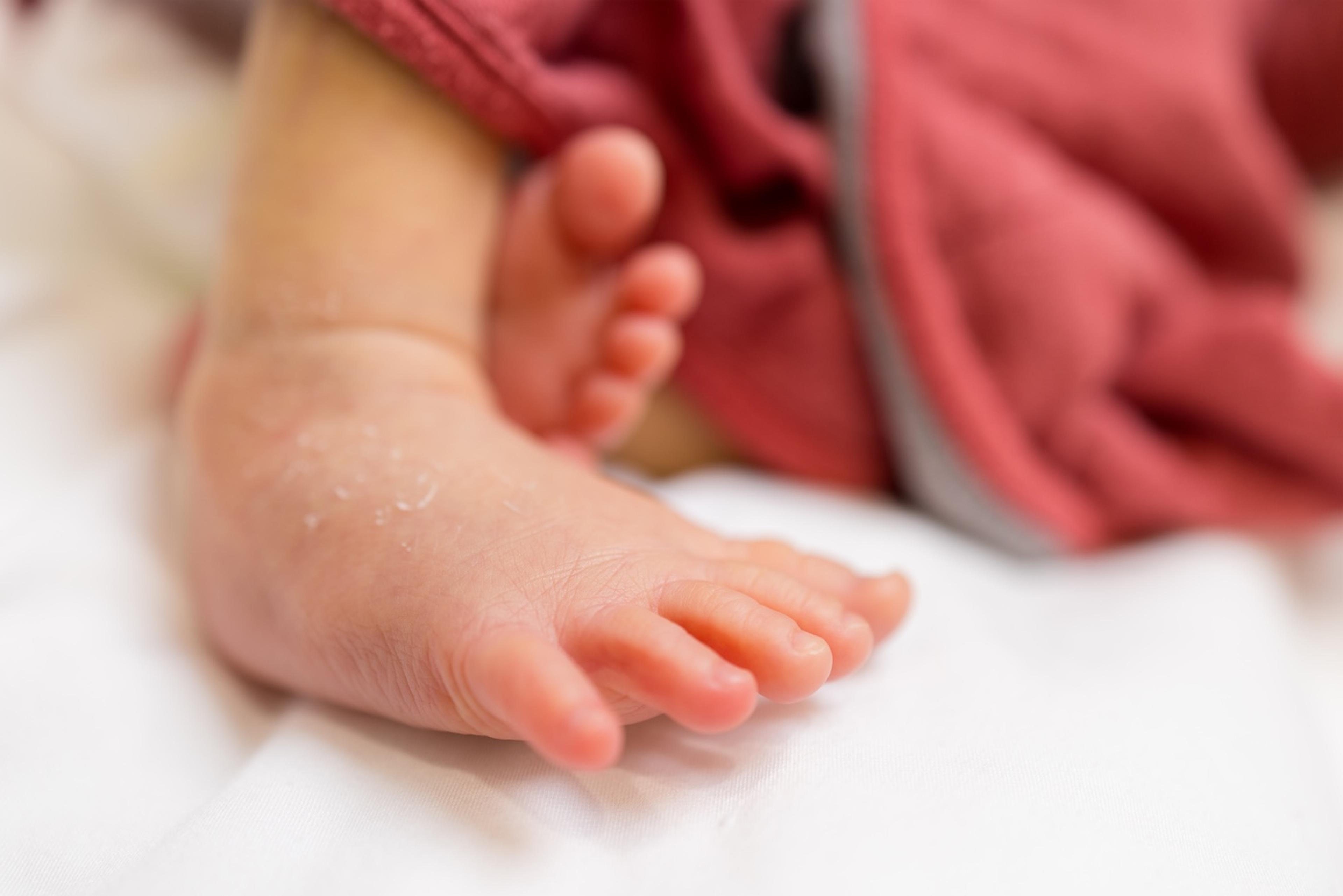 A newborn's foot with peeling skin