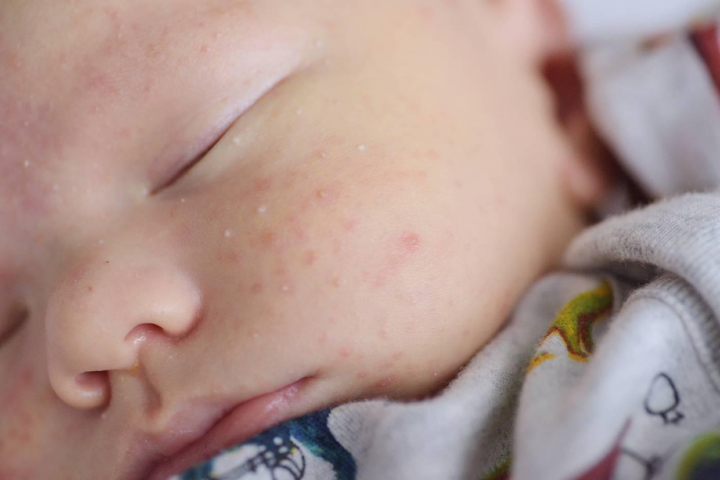 Close up of infant with baby acne