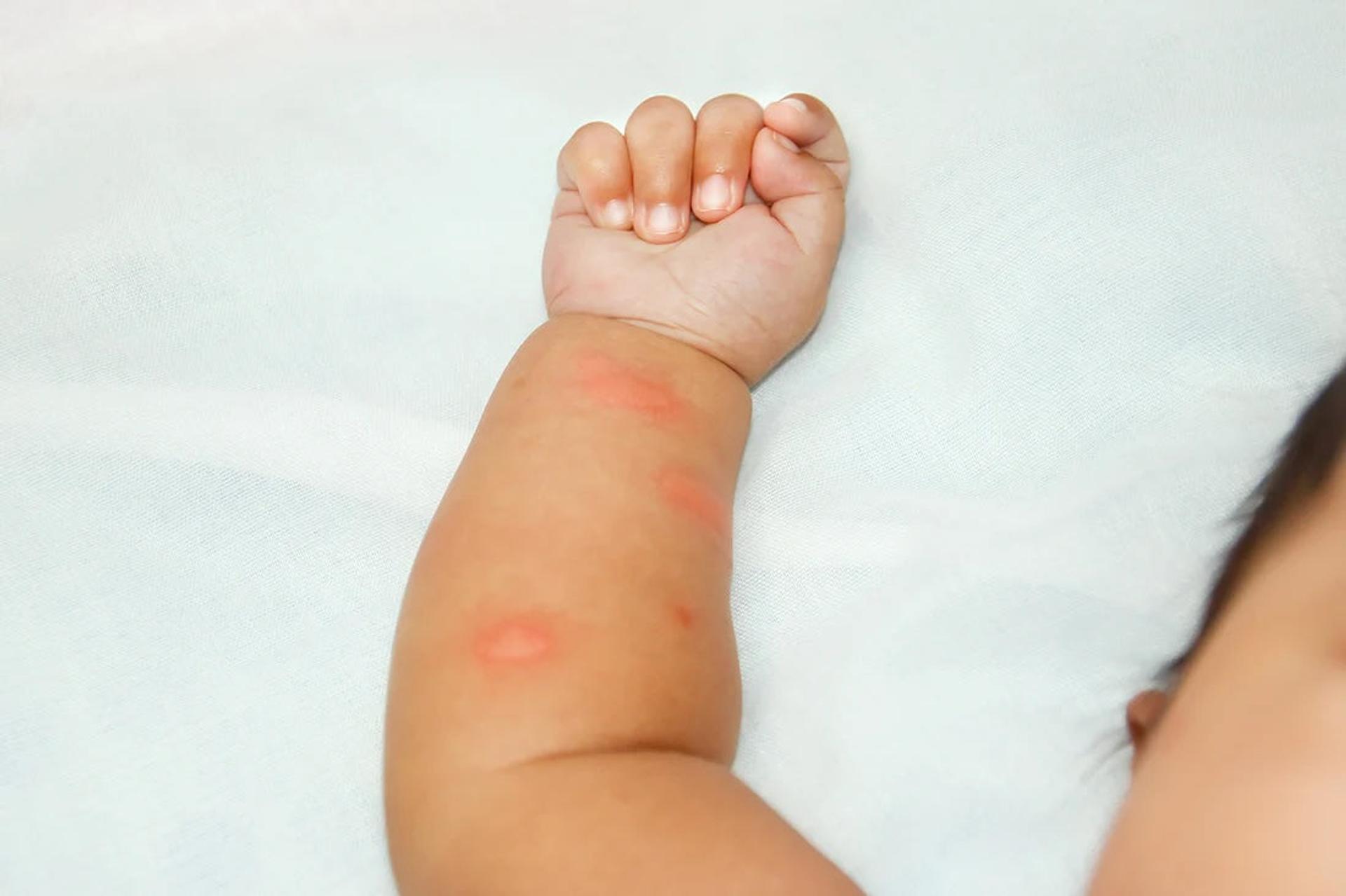 Baby's arm with mosquito bites