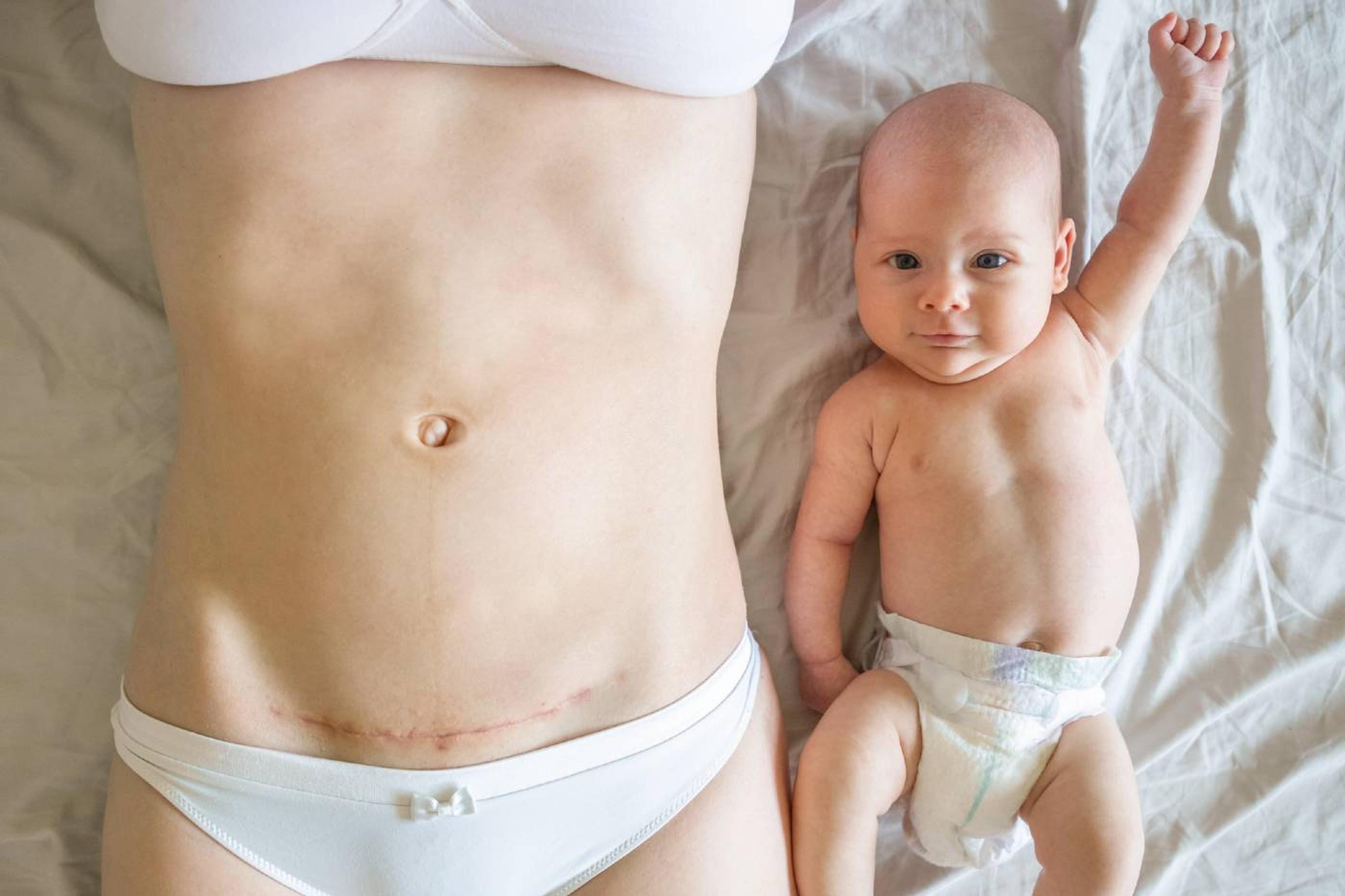mom with c-section scar alongside baby