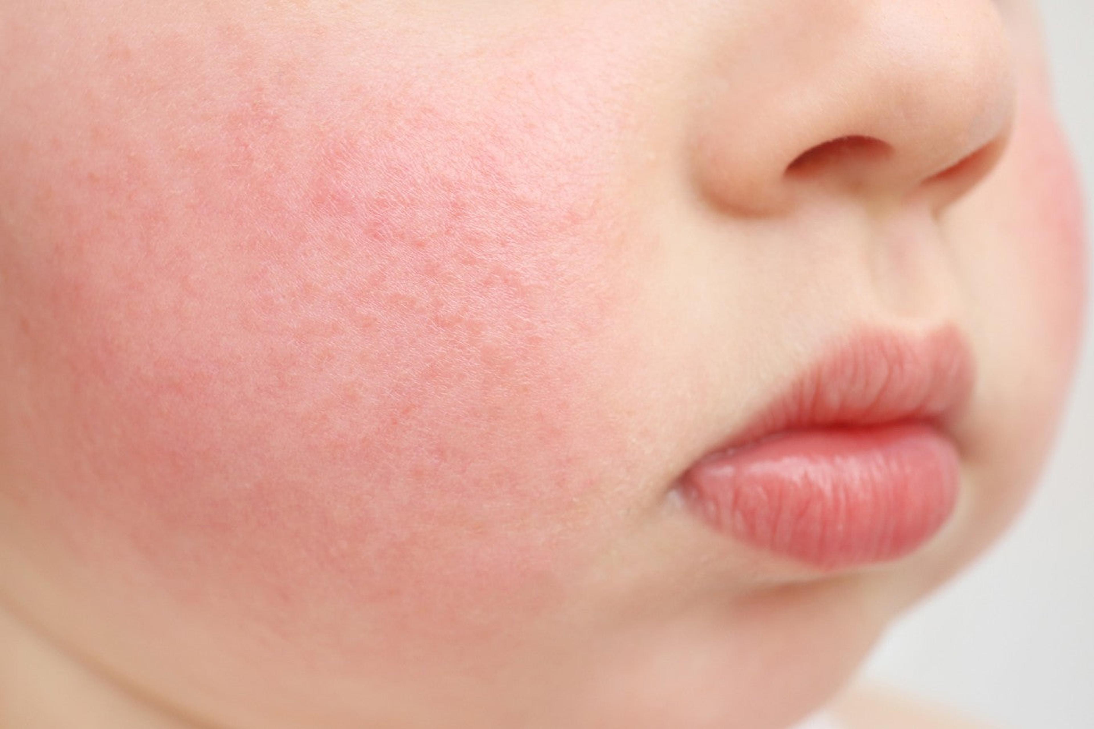 A baby's flushed cheek