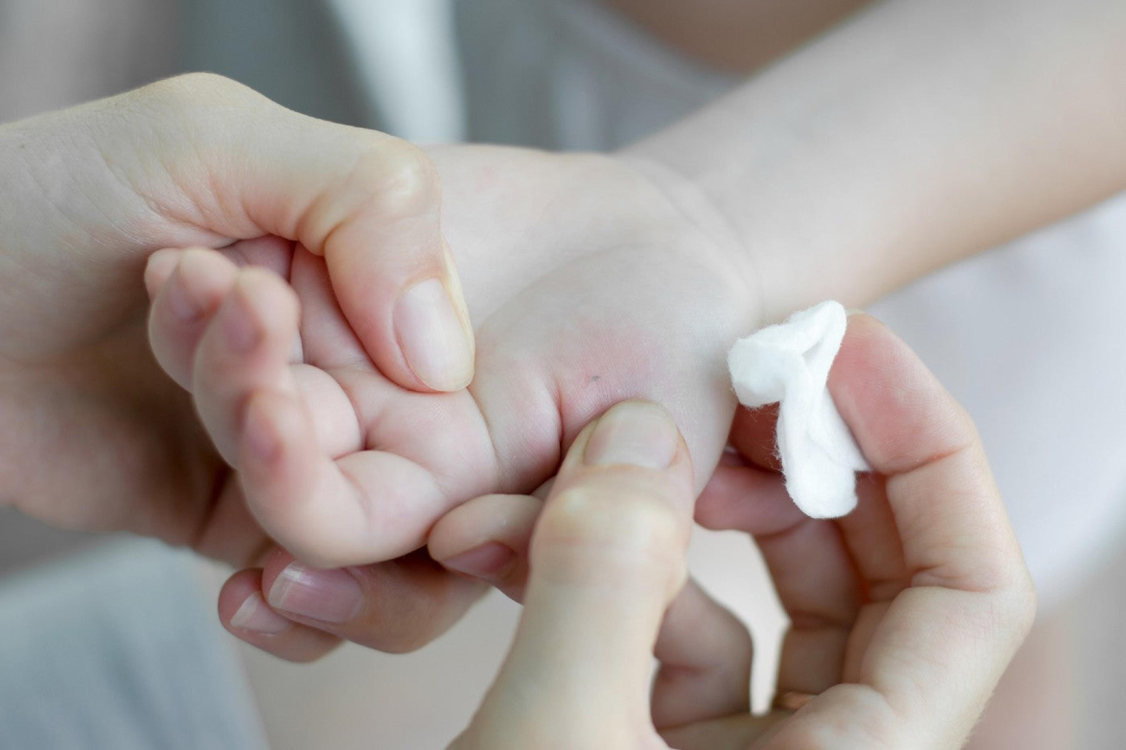 Removing a splinter from a toddler's hand
