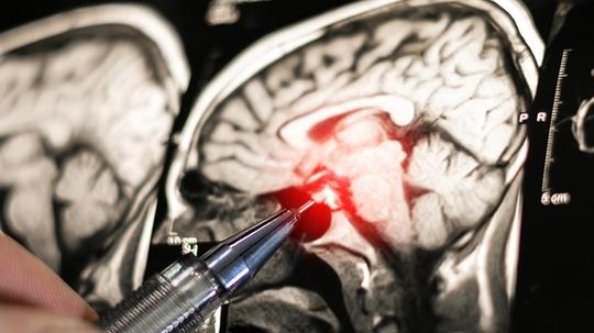 CT-scan of an brain being analyzed.