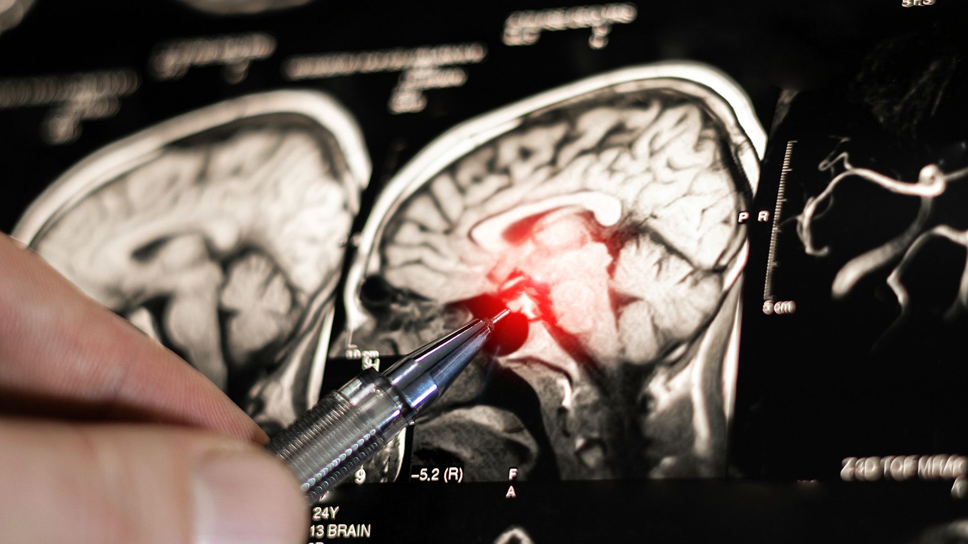CT-scan of an brain being analyzed. 